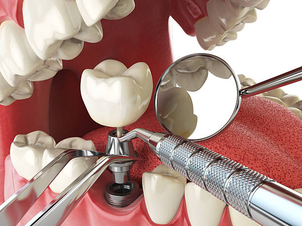 Best Urgent Dental Care for Toothache in Bel Air South, MD